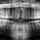 Imagen para el artículo titulado Un niño de 7 años acude al hospital con la mandíbula inflamada. Le extraen más de 500 dientes de la boca